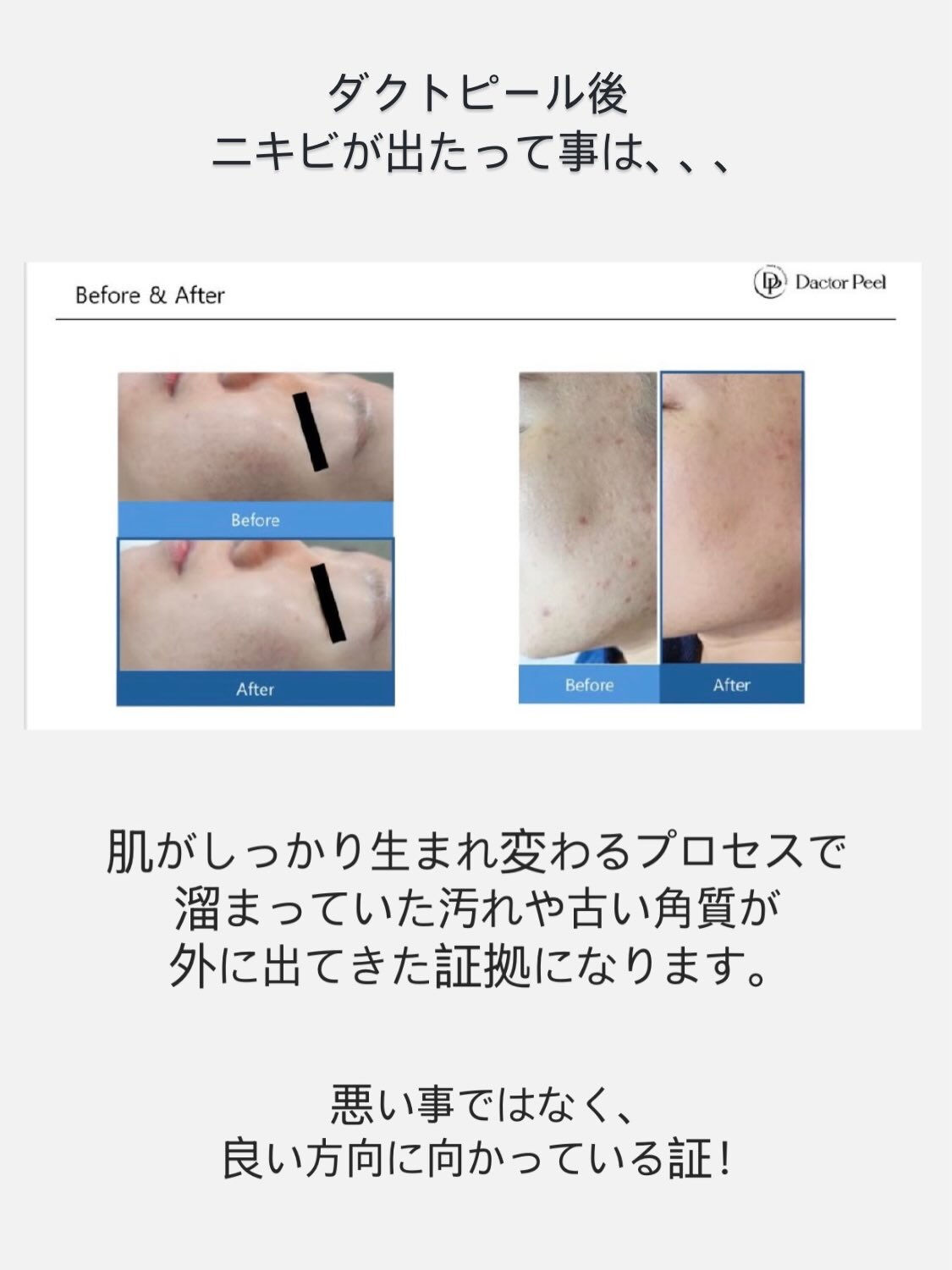 ダクトピール後、ニキビができるのは大丈夫？🤔