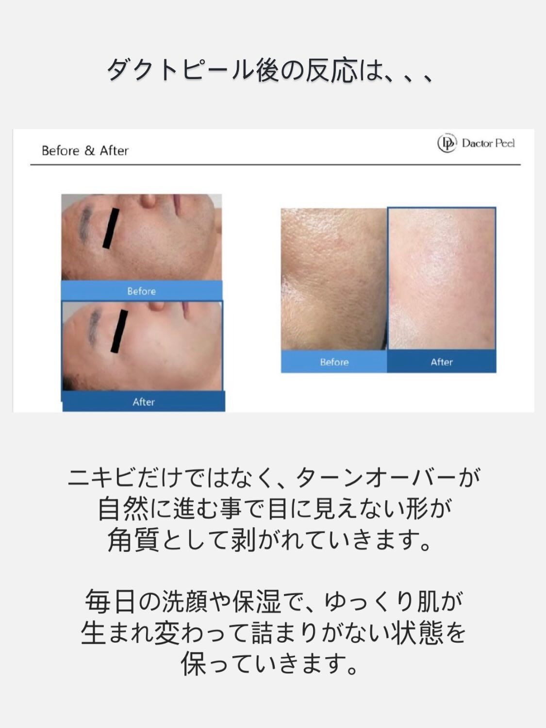 ダクトピール後、ニキビができるのは大丈夫？🤔