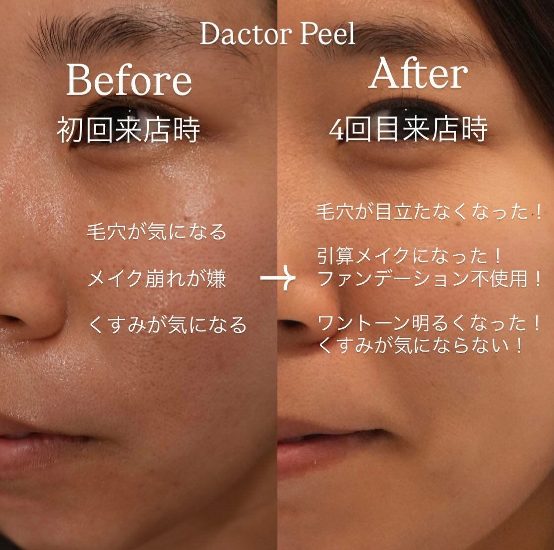 「ファンデで隠す肌」から