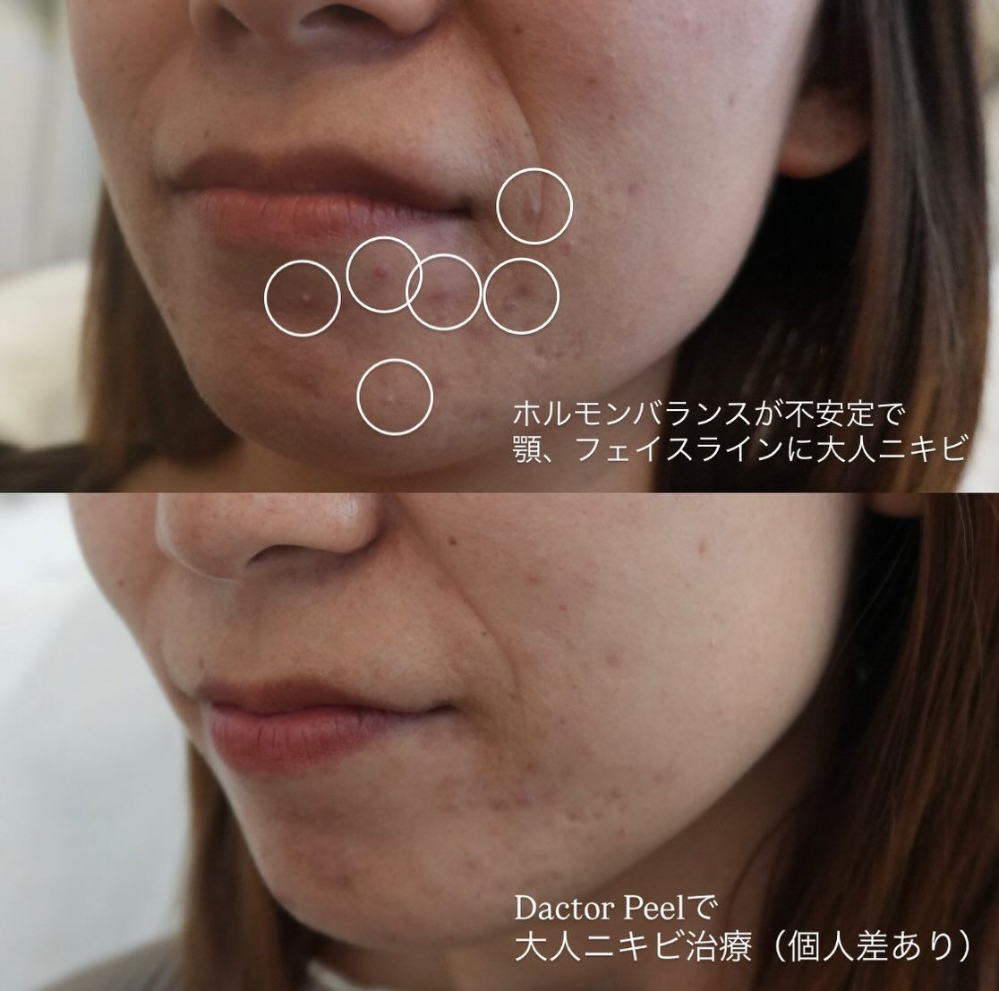「ファンデで隠す肌」から